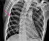 displaced rib fracture displaced rib fracture