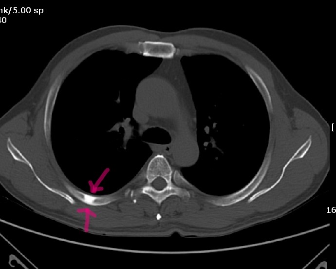 Bone island on Xray 네이버 블로그