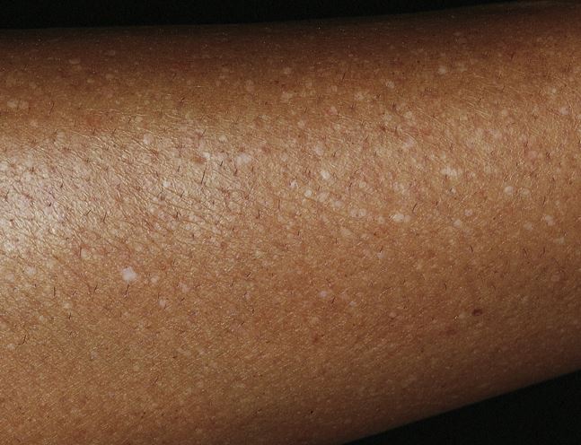 Idiopathic Guttate Hypomelanosis Wikidoc