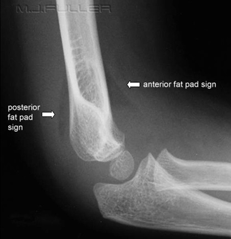 Elbow X ray Fat Pad Sign elbow-x-ray-fat-pad-sign