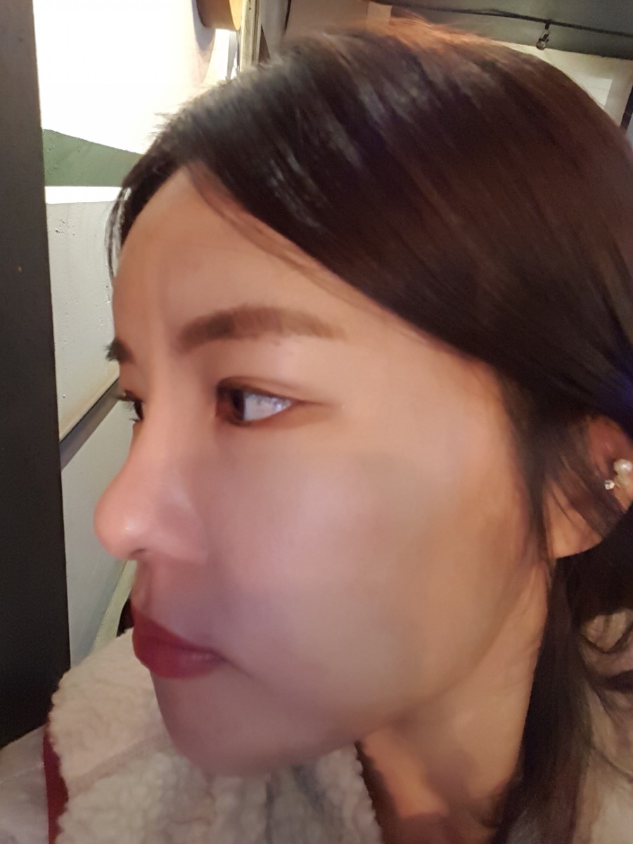 이마필러 후기 - 필러cc 붓기 통증 멍 그것이 알고싶다 : 네이버 블로그 이마필러 후기 - 필러Cc 붓기 통증 멍 그것이 알고싶다 : 네이버 블로그